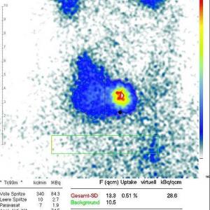 Szintigraphie In Ingolstadt | Profi Für Nuklearmedizin